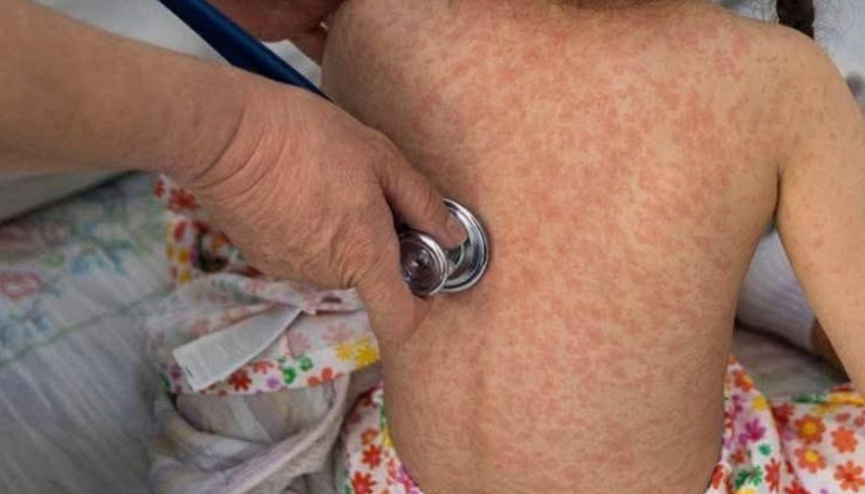 Alerta por brote de sarampión en México