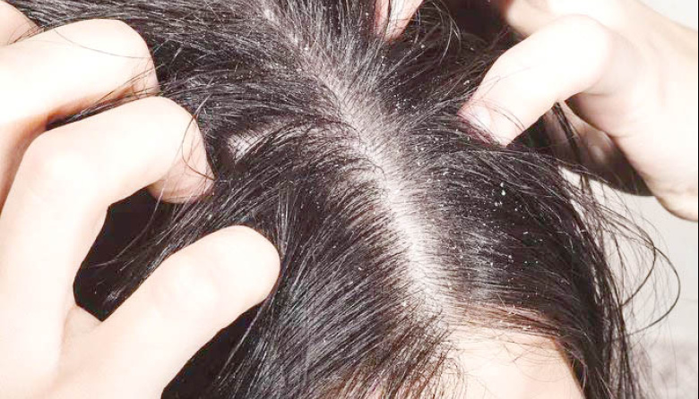 Tratamientos contra la caspa