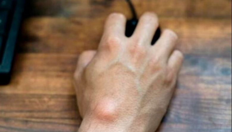 Lipomas: cuando un bulto no es motivo de alarma