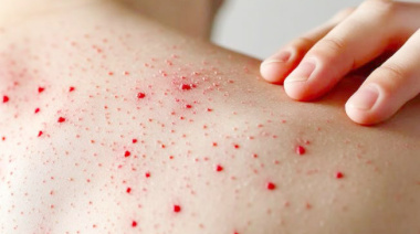 Suspenderán eventos masivos para prevenir Sarampión