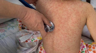 Alerta por brote de sarampión en México