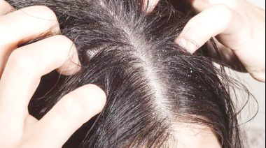 Tratamientos contra la caspa