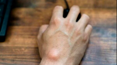 Lipomas: cuando un bulto no es motivo de alarma